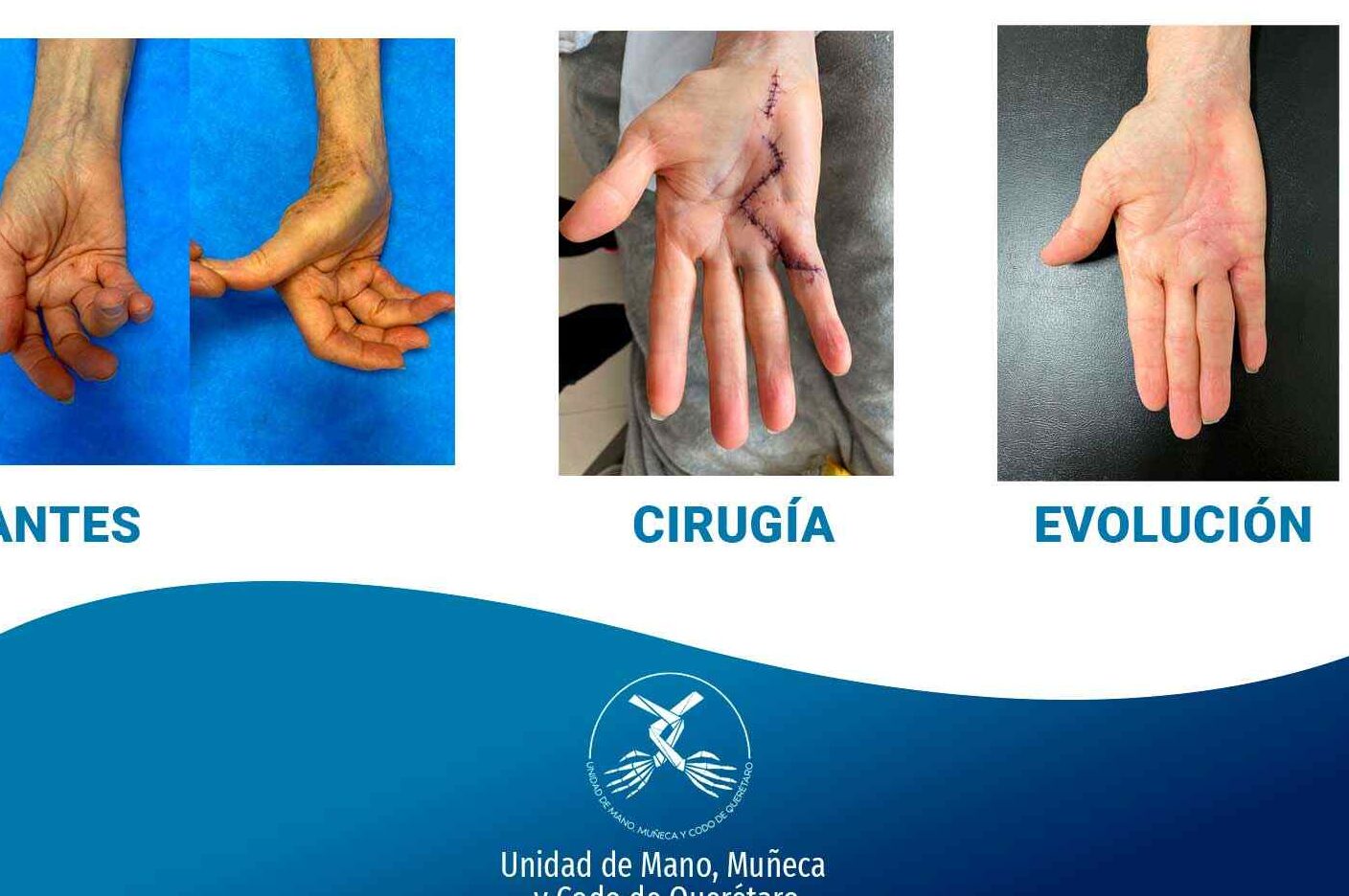cirugia de mano en queretaro unidad de mano muneca y codo