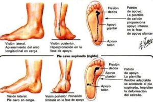 Especialista en pie plano, pie cavo, rotación interna, etc.