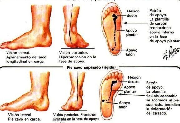 Especialista en pie plano, pie cavo, rotación interna, etc. 1 especialista en pie plano pie cavo rotacion interna etc