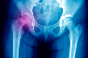 SaltilloSpine Doctor Especialista en Columna Vertebral y Traumatología Ortopedia en Saltillo